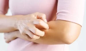 SUS: Tratamento Integral para Dermatite Atópica