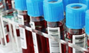EXAME: Biópsia Líquida a Revolução no Tratamento Oncológico com Exame de Sangue
