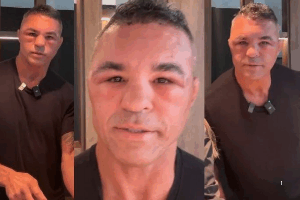 IRRECONHECÍVEL: Vitor Belfort Aparece com Rosto Inchado após Procedimento Estético