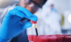 DIAGNÓSTICO: Exame de Sangue pode Detectar Tumor Cerebral com Mais de 90% de Precisão, Dizem Cientistas