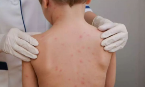 ALERTA: O Dia Mundial de Combate à Meningite no Brasil Preocupa com a Baixa Vacinação e Novos Sorotipos 